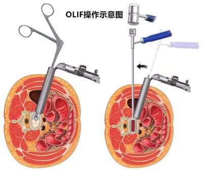 同仁医院熊猫体育官网这项技术让患者远离腰椎滑脱(图2)